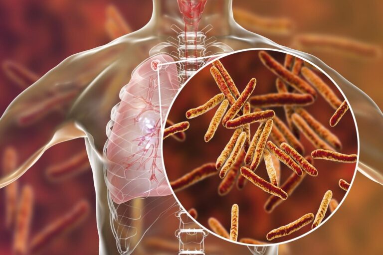 Archivo - Tuberculosis